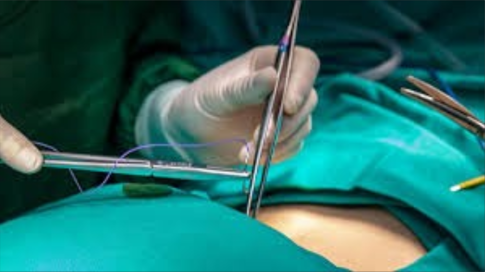 Por primera vez, un hígado de cerdo genéticamente modificado logró mantener con vida a un ser humano durante casi 6 meses